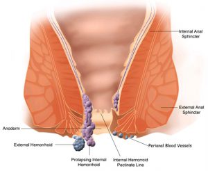 hemorrhoid