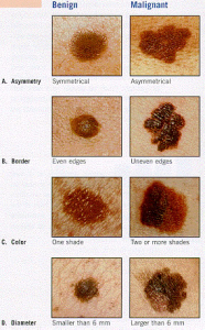 melanoma types